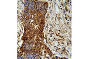 Immunohistochemical staining of formalin-fixed and paraffin-embedded human lung carcinoma reacted with MMP2 monoclonal antibody  at 1:50-1:100 dilution. (MMP2 antibody)