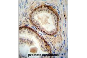 NUDT8 antibody immunohistochemistry analysis in formalin fixed and paraffin embedded human prostate carcinoma followed by peroxidase conjugation of the secondary antibody and DAB staining.