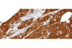 Immunohistochemistry of paraffin-embedded Human breast cancer tissue using LIPG Polyclonal Antibody at dilution of 1:50(x200) (LIPG antibody)