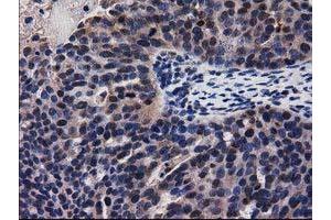 Immunohistochemical staining of paraffin-embedded Carcinoma of Human kidney tissue using anti-ADSL mouse monoclonal antibody. (Adenylosuccinate Lyase antibody)