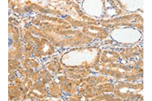 The image on the left is immunohistochemistry of paraffin-embedded Human thyroid cancer tissue using ABIN7189848(APOB Antibody) at dilution 1/10, on the right is treated with synthetic peptide. (APOB antibody)