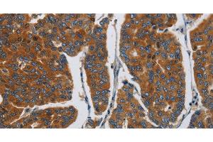 Immunohistochemistry of paraffin-embedded Human breast cancer using APEH Polyclonal Antibody at dilution of 1:30 (APEH antibody)