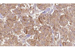 ABIN6268679 at 1/100 staining Human Melanoma tissue by IHC-P. (IL12A antibody  (Internal Region))