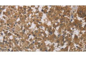 Immunohistochemistry of paraffin-embedded Human thyroid cancer using Cytochrome b5 Polyclonal Antibody at dilution of 1:40 (Cytochrome b5 (CYTB5) antibody)