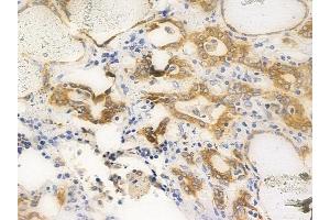 ABIN6256416 and ABIN6267653 at 1/100 staining human thyroid carcinoma by IHC-P. (PKD1/2/3/PKC mu (pSer738), (pSer742) antibody)