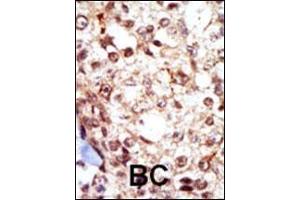 Formalin-fixed and paraffin-embedded human cancer tissue reacted with the primary antibody, which was peroxidase-conjugated to the secondary antibody, followed by AEC staining. (Fgr antibody  (N-Term))