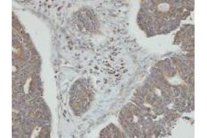 Immunohistochemistry: PP2C kappa/PPM1K antibody staining of Paraffin-Embedded endo mitral OVCA at 1/100 dilution. (PPM1K antibody  (N-Term))