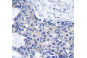 Immunohistochemistry of paraffin-embedded Human breast carcinoma tissue, using Phospho-ZAP70(Y493) Polyclonal Antibody (ZAP70 antibody  (pTyr493))