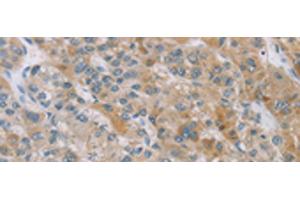 Immunohistochemistry of paraffin-embedded Human liver cancer tissue using ZAK Polyclonal Antibody at dilution of 1:100(x200) (ZAK antibody)
