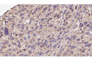ABIN6272277 at 1/100 staining Human Melanoma tissue by IHC-P. (COL19A1 antibody)