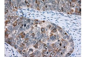 Immunohistochemical staining of paraffin-embedded Adenocarcinoma of Human colon tissue using anti-CD5 mouse monoclonal antibody. (CD5 antibody)
