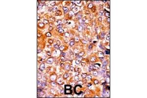 Formalin-fixed and paraffin-embedded human cancer tissue reacted with the primary antibody, which was peroxidase-conjugated to the secondary antibody, followed by AEC staining. (MYT1 antibody  (pThr495))