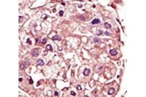 IHC analysis of FFPE human hepatocarcinoma tissue stained with the TGF Beta Receptor antibody