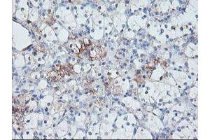 Immunohistochemical staining of paraffin-embedded Carcinoma of Human kidney tissue using anti-SERPINE2 mouse monoclonal antibody.