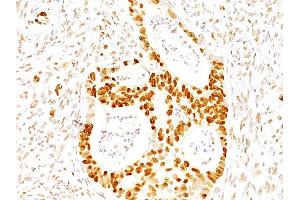 Formalin-fixed, paraffin-embedded human Colon Carcinoma stained with p27 Mouse Monoclonal Antibody (SX53G8). (CDKN1B antibody)