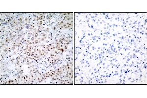 P-Peptide - +Immunohistochemical analysis of paraffin-embedded human breast carcinoma tissue using CREB (phospho-Ser133) antibody. (CREB1 antibody  (pSer133))