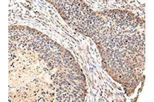 The image on the left is immunohistochemistry of paraffin-embedded Human esophagus cancer tissue using ABIN7128081(VIL1 Antibody) at dilution 1/30, on the right is treated with fusion protein. (Villin 1 antibody)