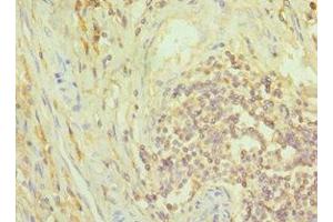 Immunohistochemistry of paraffin-embedded human colon cancer using ABIN7149352 at dilution of 1:100 (NCK1 antibody  (AA 58-377))