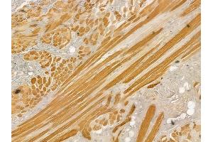 ABIN6257189 and ABIN6273408 at 1/100 staining human tongue carcinoma by IHC-P.