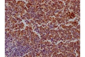 IHC image of ABIN7149714 diluted at 1:100 and staining in paraffin-embedded human lung cancer performed on a Leica BondTM system. (SAMHD1 antibody  (AA 1-314))