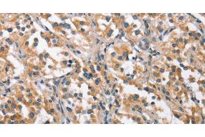 Immunohistochemistry of paraffin-embedded Human thyroid cancer using CHMP1A Polyclonal Antibody at dilution of 1:60 (CHMP1A antibody)