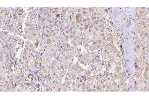 ABIN6273314 at 1/100 staining Human thyroid cancer tissue by IHC-P. (EXOC3 antibody  (Internal Region))