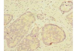 Immunohistochemistry of paraffin-embedded human gastric cancer using ABIN7171988 at dilution of 1:100