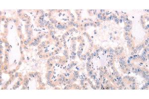 Immunohistochemistry of paraffin-embedded Human thyroid cancer using TRAF3IP1 Polyclonal Antibody at dilution of 1:70 (TRAF3IP1 antibody)
