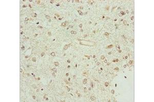 Immunohistochemistry of paraffin-embedded human glioma using ABIN7159847 at dilution of 1:100 (BCS1L antibody  (AA 33-240))