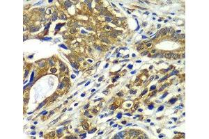 Immunohistochemistry of paraffin-embedded Human gastric cancer using CDC16 Polyclonal Antibody at dilution of 1:100 (40x lens).