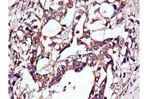 Immunohistochemistry of paraffin-embedded human gastric cancer using ABIN7173671 at dilution of 1:100 (TUBA4A antibody  (AA 20-183))