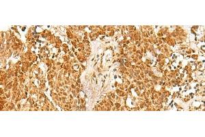 Immunohistochemistry of paraffin-embedded Human lung cancer tissue using SSSCA1 Polyclonal Antibody at dilution of 1:50(x200) (SSSCA1 antibody)