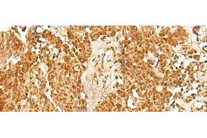 Immunohistochemistry of paraffin-embedded Human lung cancer tissue using SSSCA1 Polyclonal Antibody at dilution of 1:50(x200)