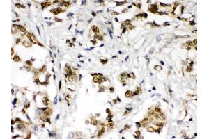 ABR was detected in paraffin-embedded sections of human mammary cancer tissues using rabbit anti- ABR Antigen Affinity purified polyclonal antibody (Catalog # ) at 1 ?