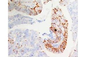 Immunohistochemical analysis of paraffin-embedded mammary cancer sections, staining MORG1 in cytoplasm, DAB staining (MORG1 antibody  (N-Term))