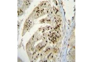Immunohistochemistry analysis in formalin fixed and paraffin embedded human prostate carcinoma reacted with AP53159PU-N, which was peroxidase conjugated to the secondary antibody and followed by DAB staining.
