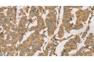 Immunohistochemistry of paraffin-embedded Human breast cancer using DMRT3 Polyclonal Antibody at dilution of 1:50 (DMRT3 antibody)