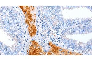 Immunohistochemistry of paraffin-embedded Human cervical cancer using ENPP7 Polyclonal Antibody at dilution of 1:50 (ENPP7 antibody)