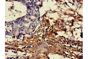 Immunohistochemistry of paraffin-embedded human gastric cancer using ABIN7149454 at dilution of 1:100 (DDO antibody  (AA 37-161))
