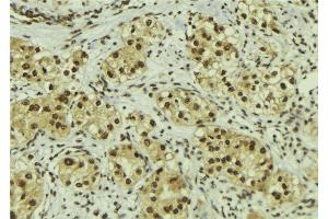 ABIN6267184 at 1/100 staining Human breast cancer tissue by IHC-P. (SQSTM1 antibody  (pSer272, pThr269))