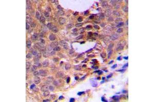 Immunohistochemical analysis of CDC2 (pT161) staining in human breast cancer formalin fixed paraffin embedded tissue section. (CDK1 antibody  (pSer161))