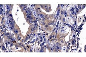 Detection of ITGaV in Human Stomach cancer Tissue using Polyclonal Antibody to Integrin Alpha V (ITGaV) (CD51 antibody  (AA 560-744))