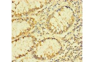 Immunohistochemistry of paraffin-embedded human colon cancer using ABIN7142550 at dilution of 1:100 (FAU antibody  (AA 1-59))
