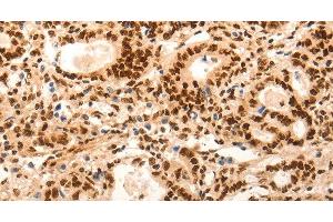 Immunohistochemistry of paraffin-embedded Human gasrtic cancer tissue using E2F7 Polyclonal Antibody at dilution 1:60 (E2F7 antibody)