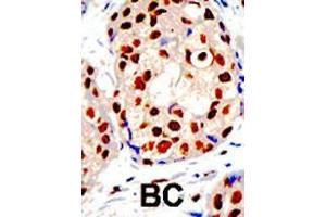 Formalin-fixed and paraffin-embedded human cancer tissue reacted with the primary antibody, which was peroxidase-conjugated to the secondary antibody, followed by DAB staining. (PRMT1 antibody  (C-Term))