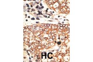 Formalin-fixed and paraffin-embedded human cancer tissue reacted with the primary antibody, which was peroxidase-conjugated to the secondary antibody, followed by AEC staining. (Neuregulin 2 antibody  (C-Term))