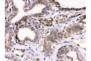 Anti- Parvin alpha Picoband antibody, IHC(P) IHC(P): Human Mammary Cancer Tissue (Parvin alpha antibody  (Middle Region))
