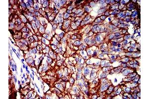 Immunohistochemical analysis of paraffin-embedded ovarian cancer tissues using CD147 mouse mAb with DAB staining. (CD147 antibody  (AA 138-323))