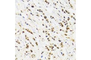 Immunohistochemistry of paraffin-embedded human breast cancer using RAD50 Antibody. (RAD50 antibody)