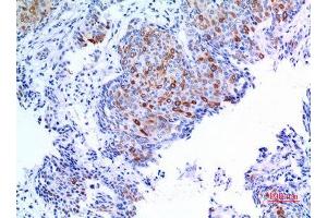 Immunohistochemistry (IHC) analysis of paraffin-embedded Human Mammary Cancer, antibody was diluted at 1:100.